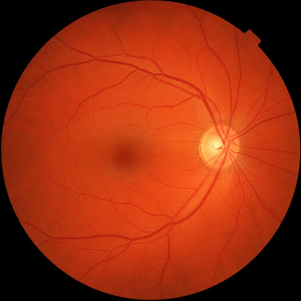 Example retinal fundus photograph
